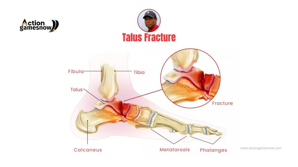Medical report on Tiger Woods' injury indicating potential damage to his talus.